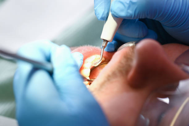 Best Emergency Tooth Extraction in North Fair Oaks, CA